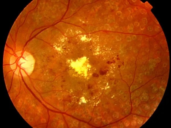 Retinopatia_Diabetica